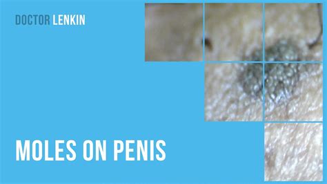 moles on the penis